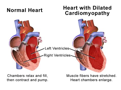 dilated cardiomyopathy vs cardiomegaly.